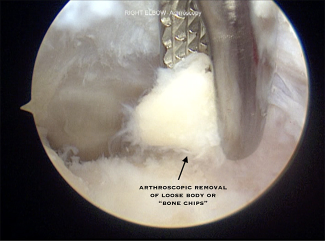Removal of Loose Bodies 2