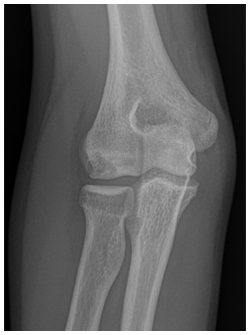 X-ray of Capitellar OCD