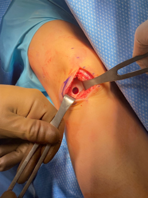 Surgical treatment of Capitellar OCD 3