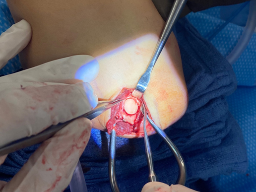 Surgical treatment of Capitellar OCD 4