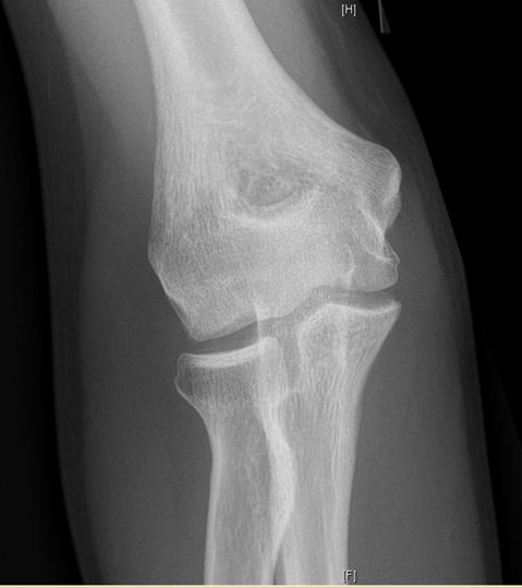 Recovery of Capitellar OCD