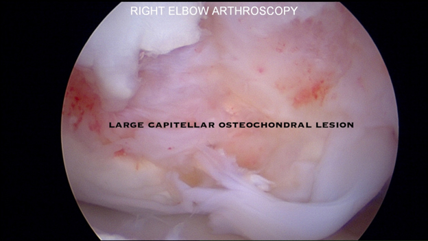 Arthroscopic examination of - OCD lesion