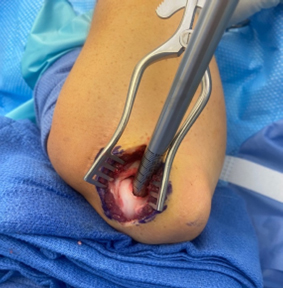 Surgical treatment of Capitellar OCD