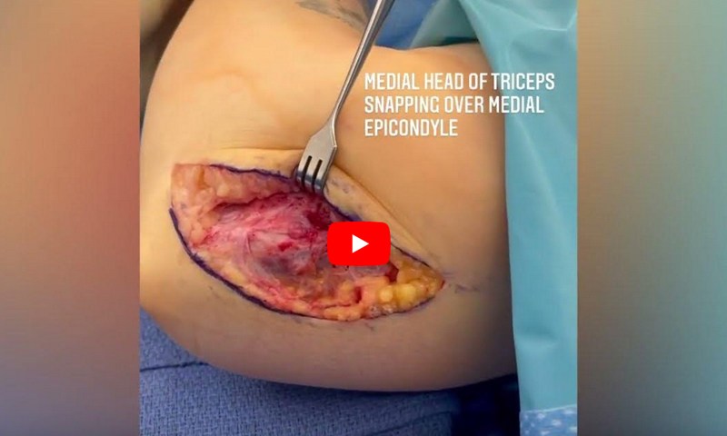 Snapping Triceps Syndrome 6