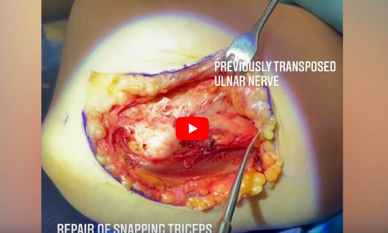 Snapping Triceps Syndrome 7