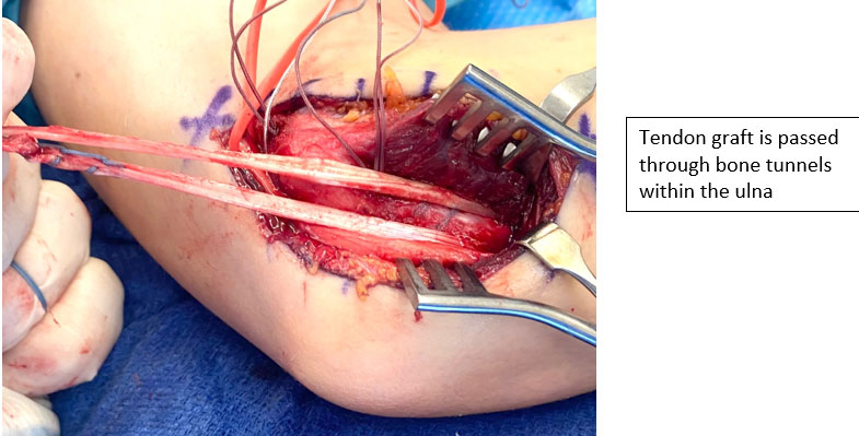 The Throwing Athlete of Tommy John Surgery