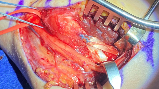 Tommy John Surgery of The Throwing Athlete