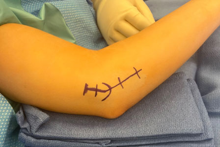 The Throwing Athletes of Tommy John Surgery