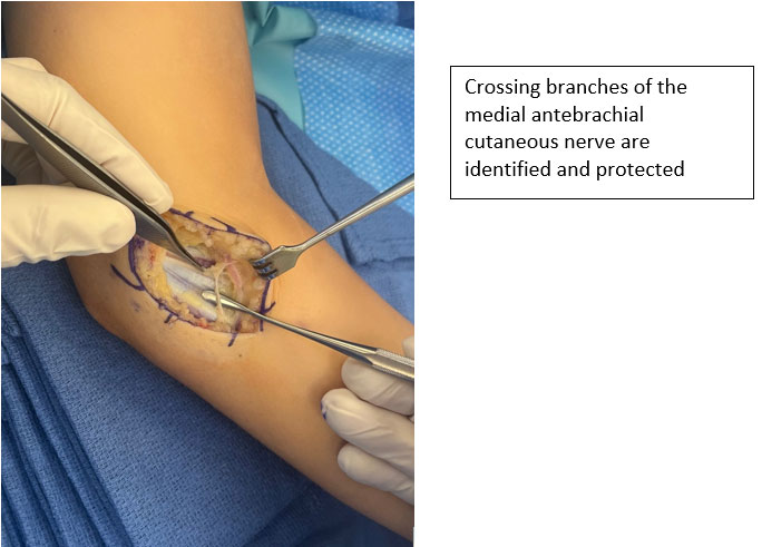 Tommy John Surgery of The Throwing Athletes