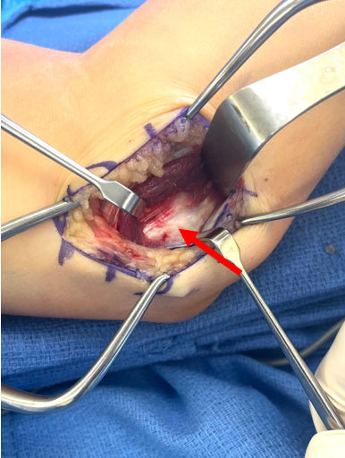 Ulnar Collateral Ligament