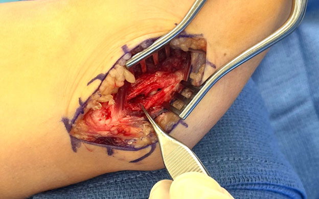 The ulnar collateral ligament/The Throwing Athlete