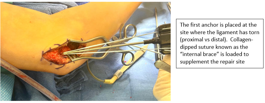 The Throwing Athlete of Elbow