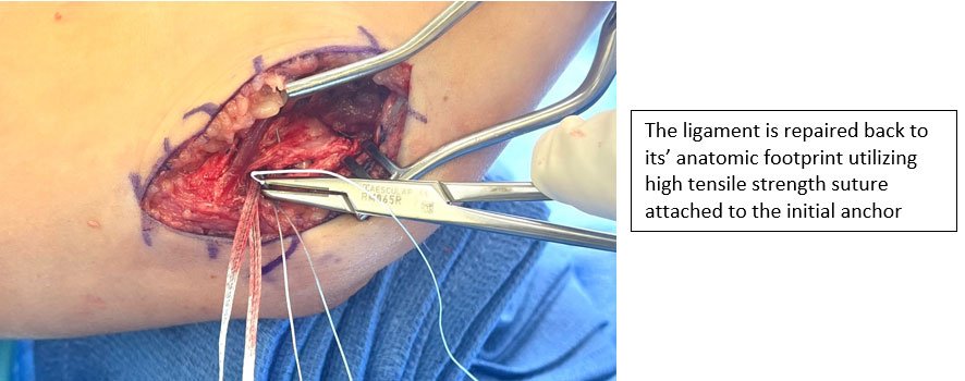 The Throwing Athlete  of the Elbow