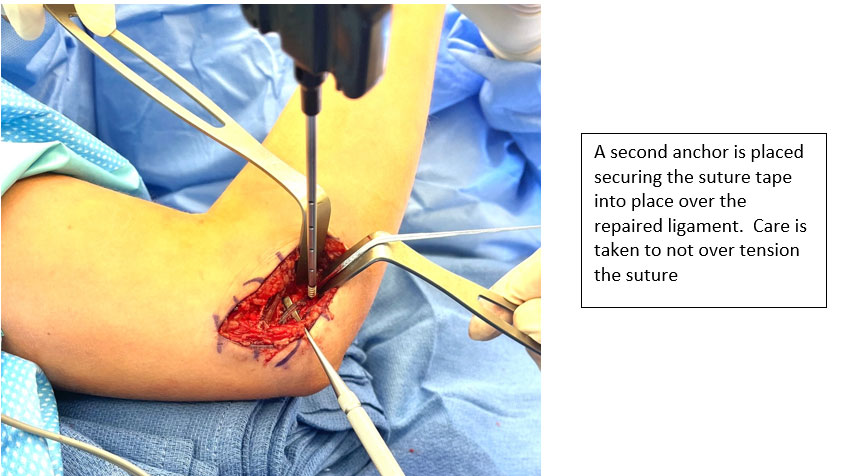 The Throwing Athlete  of Elbow Repair