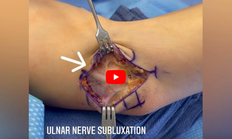 Snapping Triceps Syndrome 2