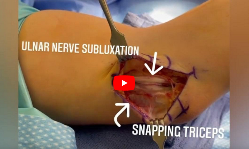 Snapping Triceps Syndrome 3