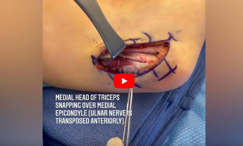 Snapping Triceps Syndrome 4