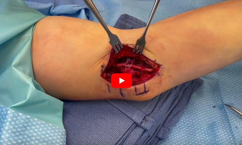 Snapping Triceps Syndrome 5