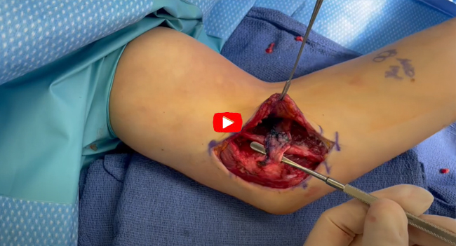 Ulnar Nerve Transposition 2