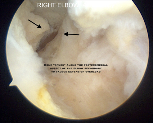 Valgus Extension Overload 9