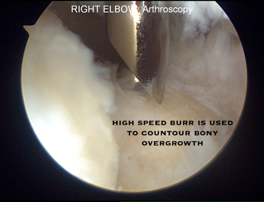 Valgus Extension Overload 10