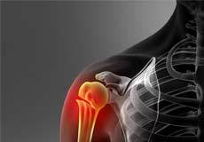 Fracture Care