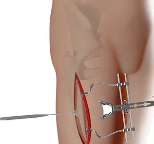 Complex Hip Reconstruction Surgery