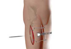 Complex Hip