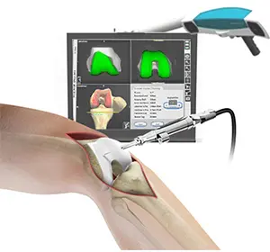 Computer Navigation For Total Knee Replacement
