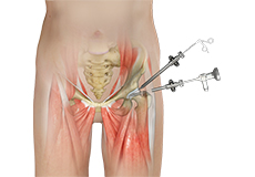 Failed Total Hip Replacement