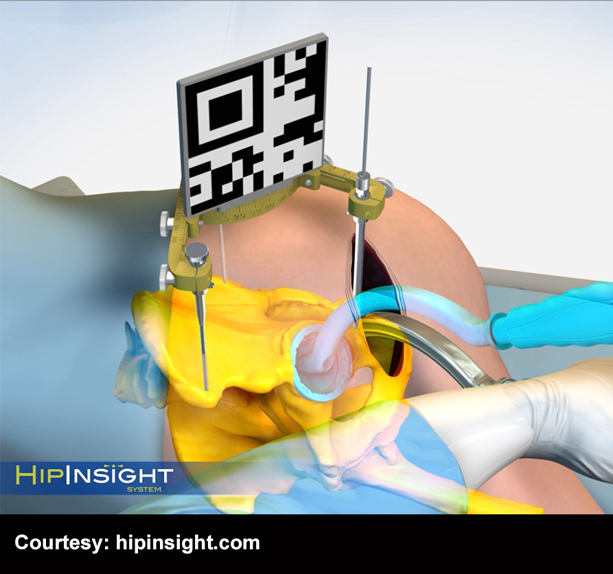 HipInsight System