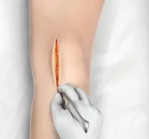 Minimally invasive Knee Joint Replacement