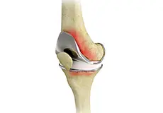 Failed Total Knee Replacement