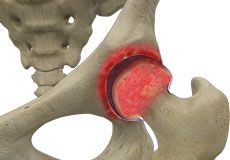 Rheumatoid Arthritis logo