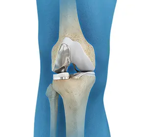 Unicompartmental Knee Replacement
