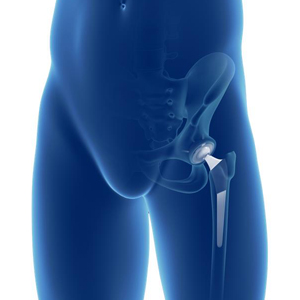Picture of Mako SmartRobotics for Total Hip Replacement
