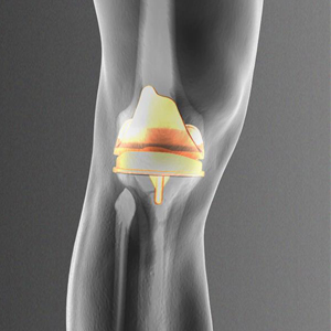 Picture of Mako SmartRobotics for Total Knee Replacement