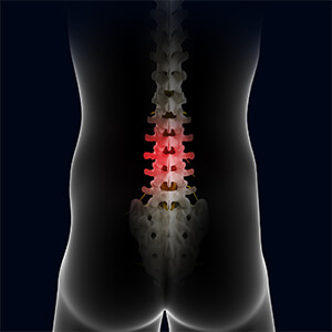 Complications of Spinal Surgery pic