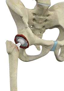 Revision Hip Joint Replacement