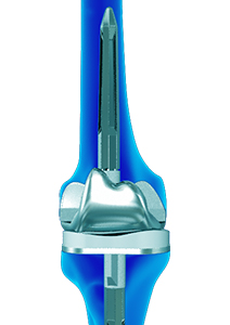 Revision Knee Joint Replacement