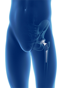 Total Hip Joint Replacement