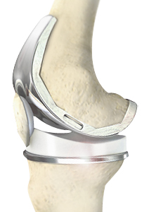 Total Knee Joint Replacement