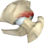 Acetabular Fracture