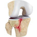 Tibial Plateau Fracture