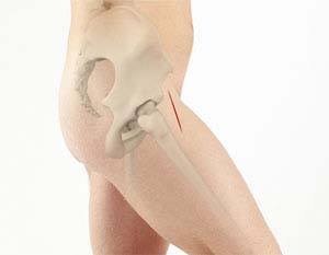 Anterior Hip Replacement  img