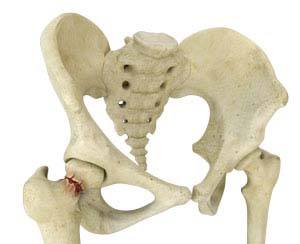Hip fracture img