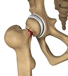Hip Injury img