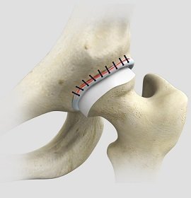Hip Reconstruction img
