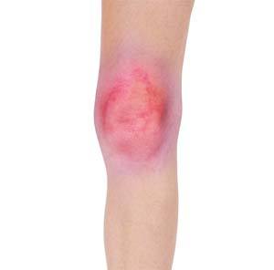 Knee Sprain img