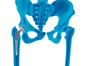 Outpatient Hip Replacement img